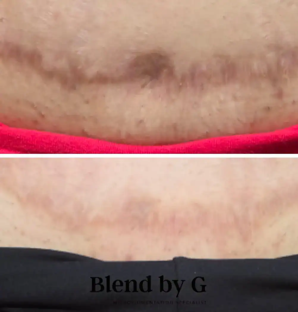Scar reduction, skin rejuvenation, cosmetic treatment, skin healing, professional skincare.