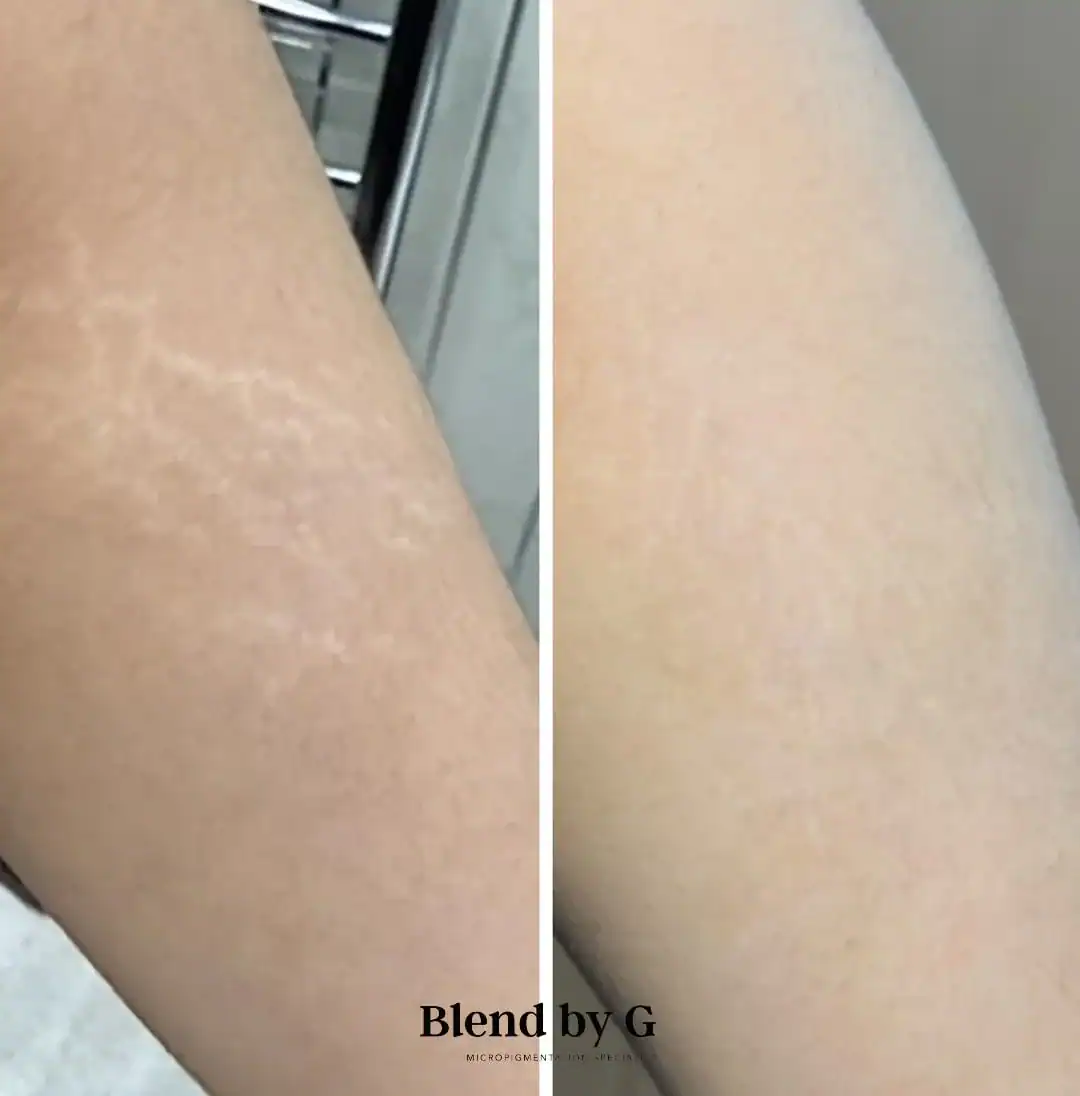 Skin improvement treatment before and after at Blend by G.