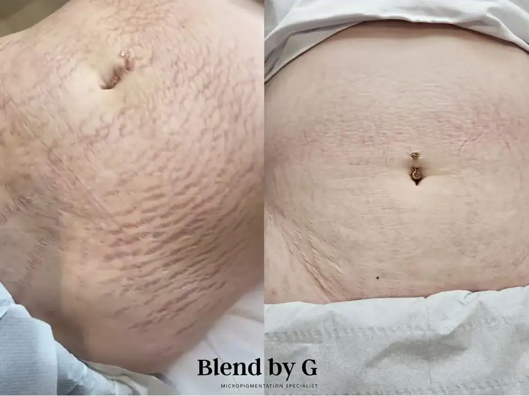Close-up of abdomen showing stretch marks before and after treatment at Blend by G.