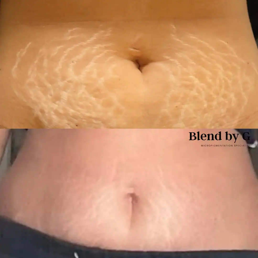 Before and after images of stretch mark removal treatment on the abdomen.