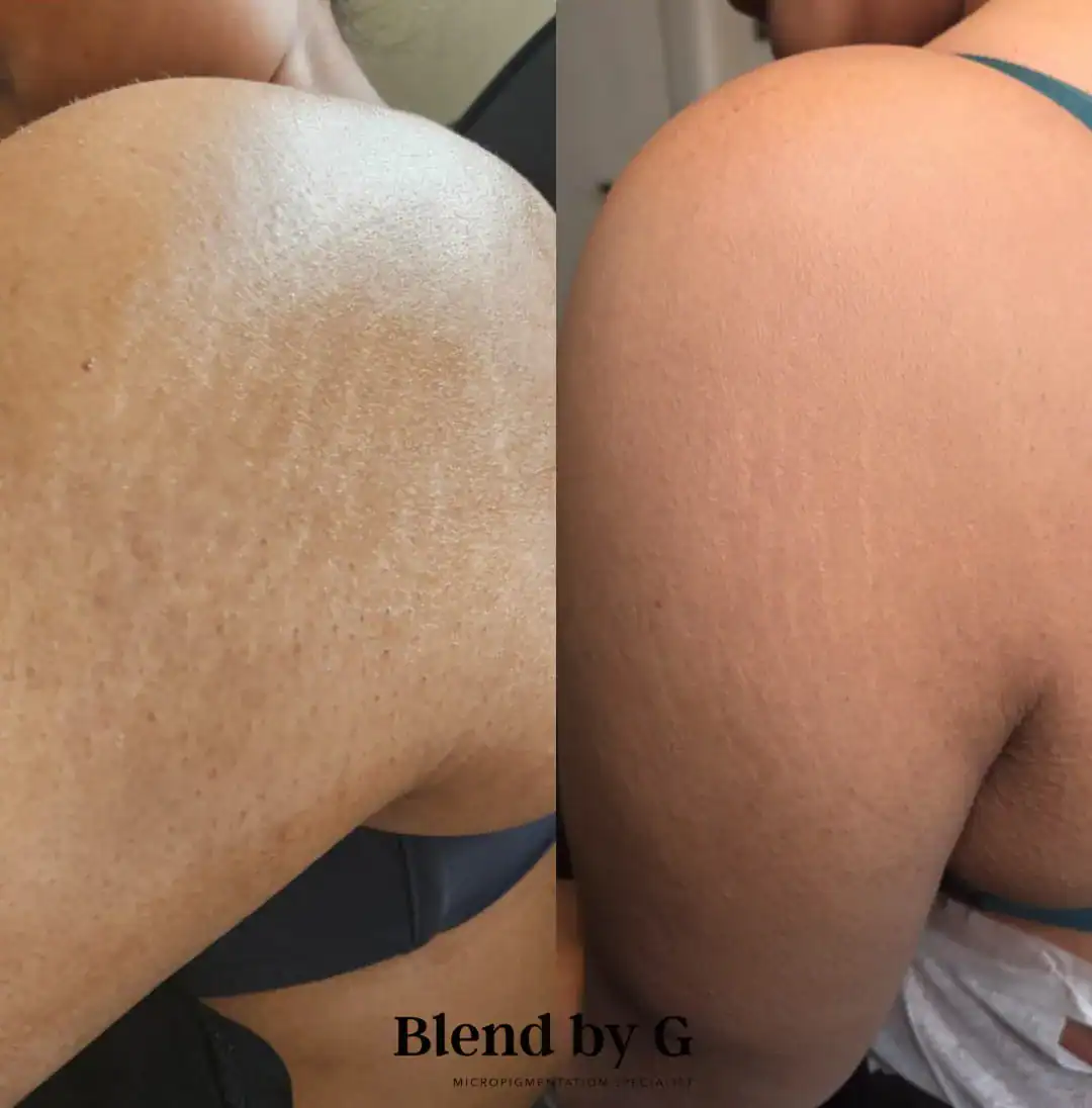 Before and after cellulite treatment showing improved skin texture on the thighs.
