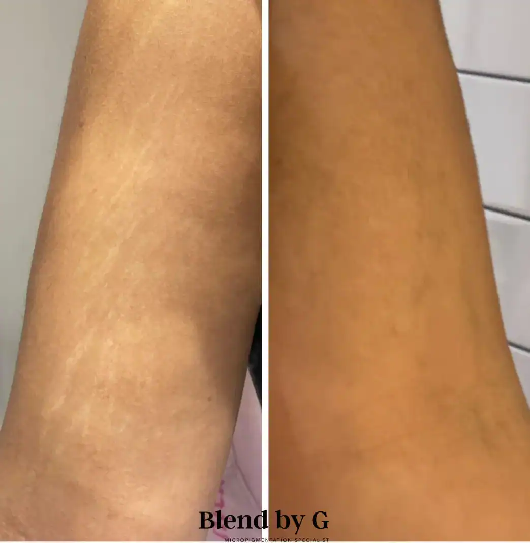 Skin improvement before and after treatment at Blend by G, showcasing effective skin rejuvenation.