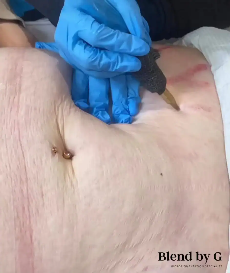 Microneedling procedure on abdominal skin for skin rejuvenation and collagen boost.