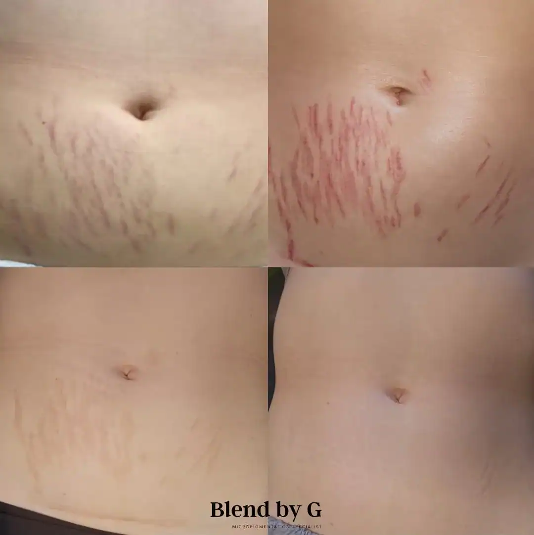 Before and after images showing stretch mark reduction on the abdomen after treatment.
