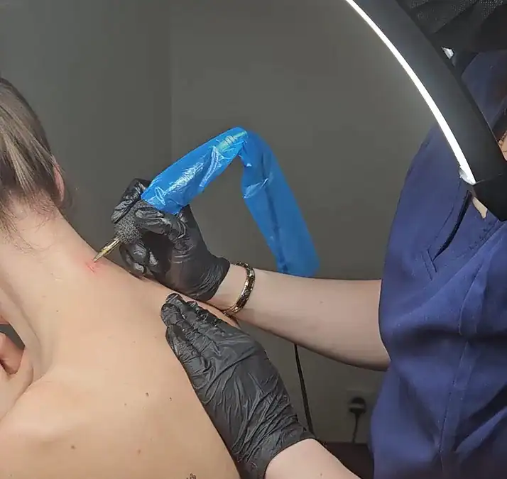 Sarah’s Scar Revision
