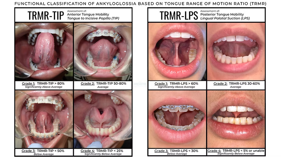 TRMR TIP and LPS