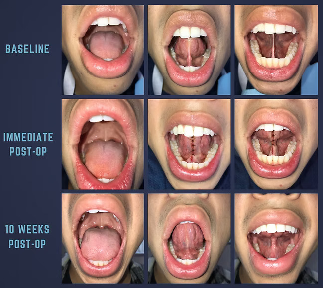 Tongue tie before and after release, Grade 3 to Grade 1, showing improved tongue mobility at baseline, immediately post-op and 10 weeks post-op