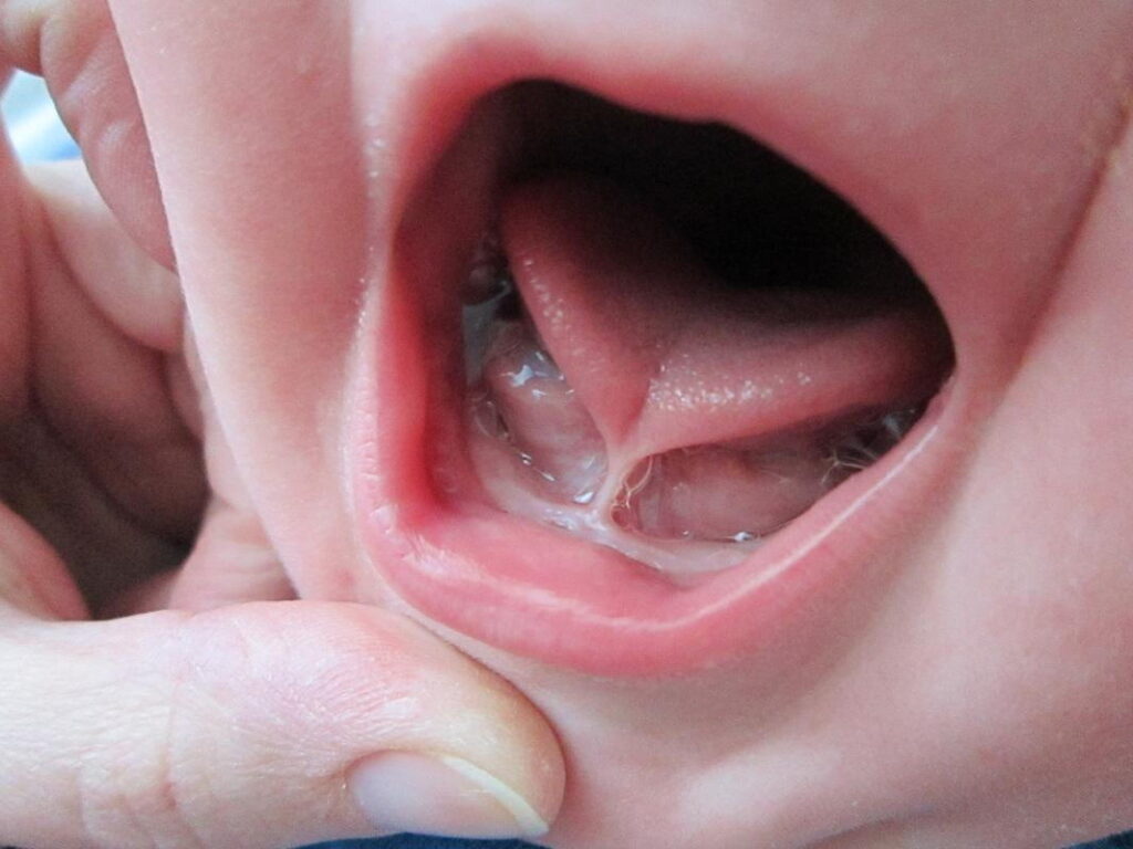 Tongue tie in a baby, the lingual frenulum visible as a tight band under the raised tongue