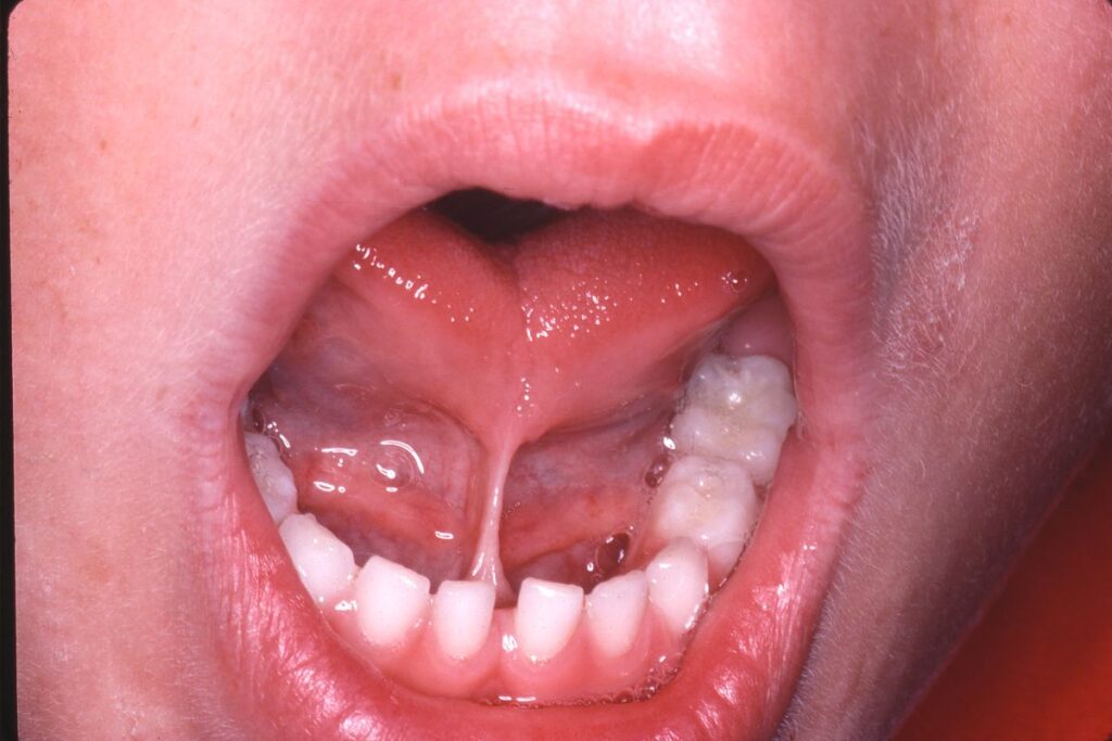 TongueTiePhot Tonguetie net