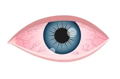 Illustration of a human eye with red veins.