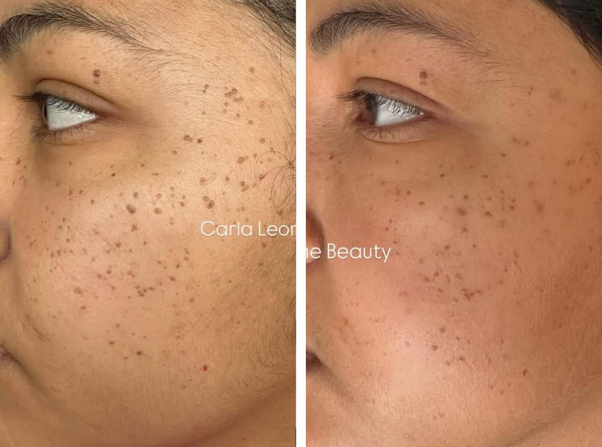 clareador_cliente-ca_25diasdeuso