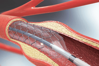 angioplasty