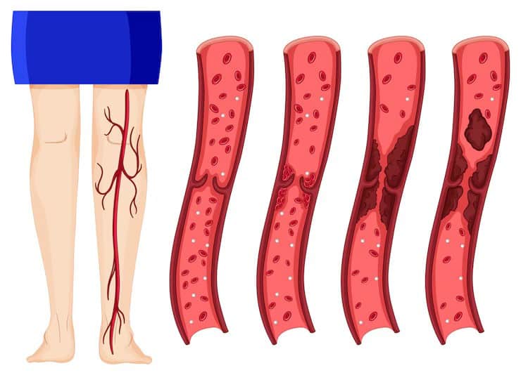 Blocked artery in leg showing progressive stages of arterial plaque buildup and narrowing of blood vessels.