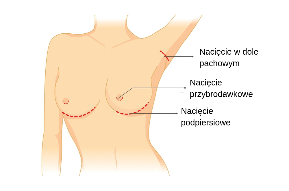 cięcia chirurgiczne podczas operacji powiększenia biustu w gabinecie medycyny estetycznej w Gdyni