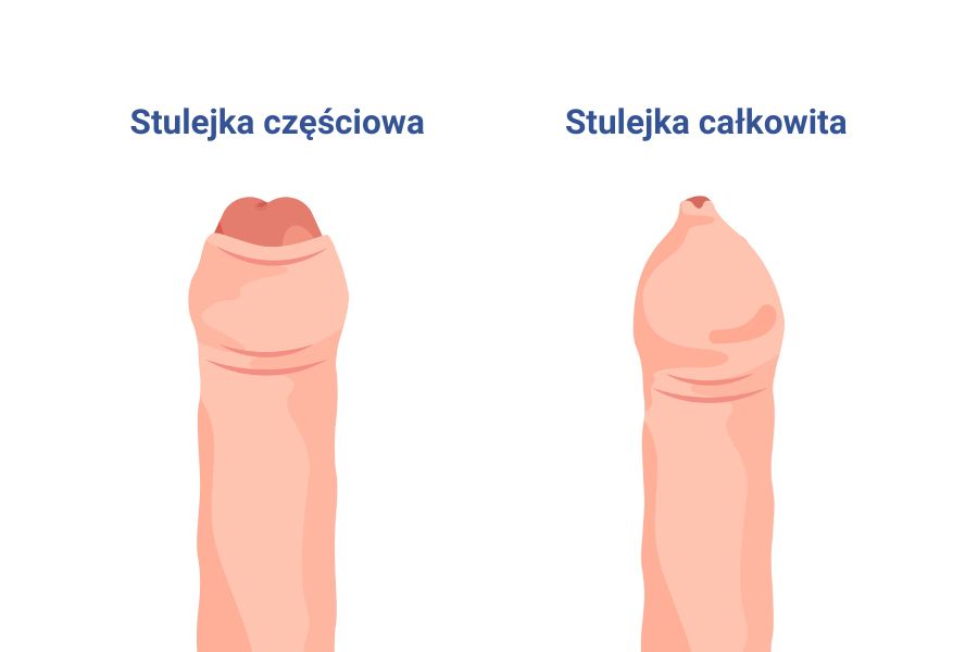 Stulejka częściowa a całkowita