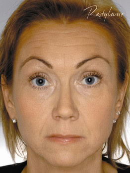 Botox przed i po - zmarszczki na czole, przy oczach, 