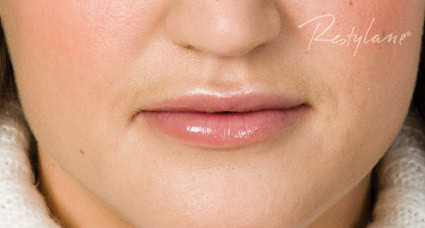 Powiększanie, nawilżanie ust kwasem hialuronowym - Gabinet Gdynia