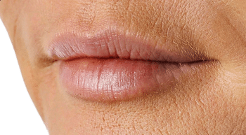 Trwałe powiększanie ust - lip lift Derm Estetyka