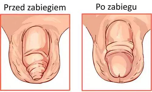 Efekty zabiegu leczenia stulejki