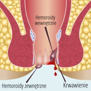 hemoroidy