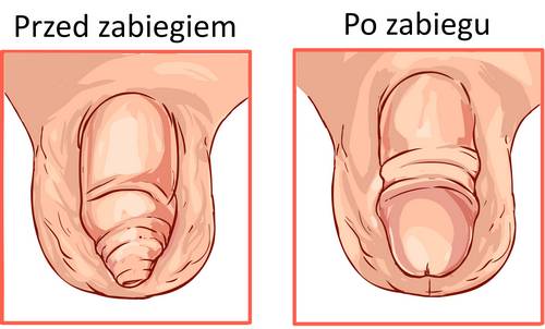 efekty zabiegu obrzezania w Gdyni