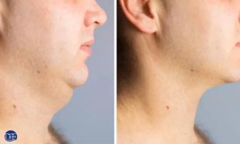 Podwojny podbrodek - liposukcja