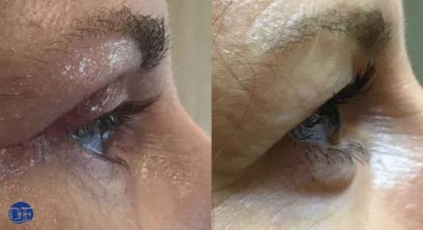 Derm Estetyka - Plastyka powiek górnych