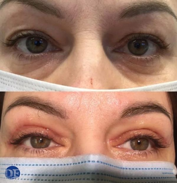 Korekta powiek przed i po - Derm Estetyka