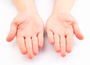 Nadpotliwość dłoni zdjęcia po zabiegu