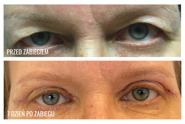 Przed zabiegiem lifting oka w gabinecie Derm-Estetyka.