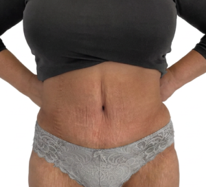 abdominoplastyk przed i po