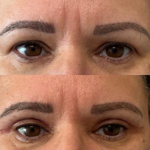 korekta powiek przed i po zabiegu