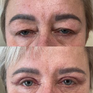 plastyka powiek przed i po 