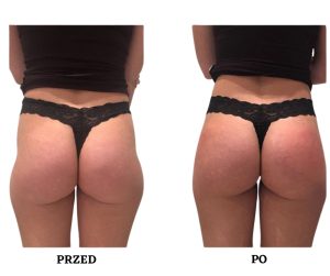 Powiekszanie posladkow