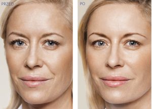 Odmładzanie twarzy Gdynia