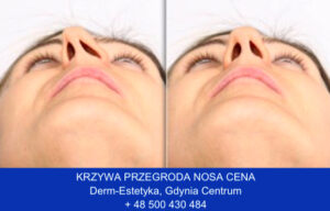 Krzywa przegroda nosowa operacja cena