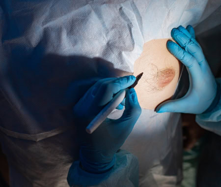 Zabieg ginekomastii w Gdyni w klinice Derm-Estetyka