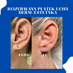 Rozerwany płatek ucha