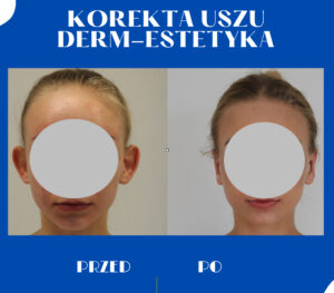 Korekta uszu przed i po
