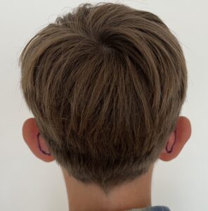 odstające uszy zabieg