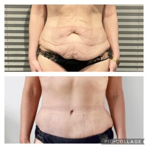 operacja plastyczna brzucha przed i po