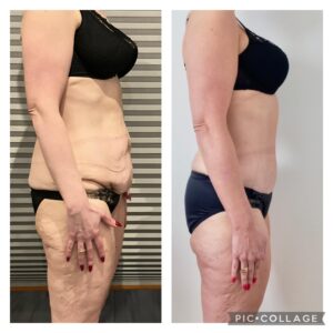 Plastyka brzucha przed i po