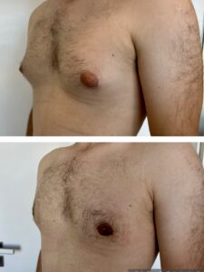 Ginekomastia przed i po