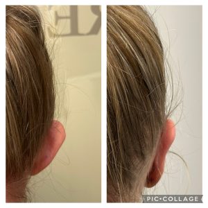 Korekta uszu przed i po