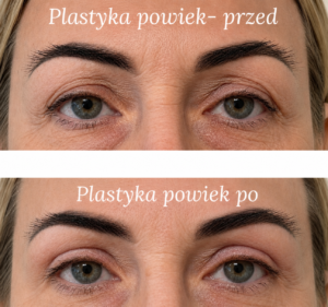 Porównanie efektów liftingu powiek w klinice Derm-Estetyka.
