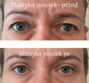 Plastyka powiek – efekt przed i po zabiegu , plastyka powiek gdynia, plastyka powiek gdańsk, zabieg na opadającą powiekę efekty