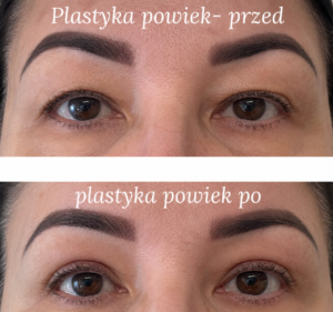 Plastyka powiek – efekt przed i po zabiegu , plastyka powiek gdynia, plastyka powiek gdańsk