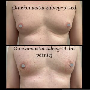 Ginekomastia przed i po 
