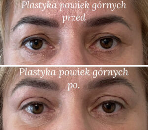 plastyka powiek przed i po 
