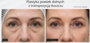 Blefaroplastyka powiek dolnych z transpozycją tłuszczu przed i po, gdynia, gdańsk